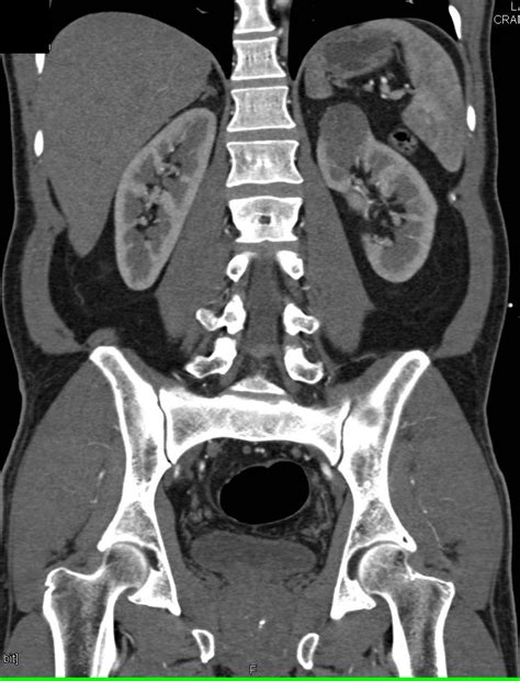 High Density Cyst Upper Pole Left Kidney Kidney Case Studies Ctisus