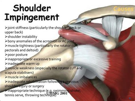 Ppt Shoulder Impingement Syndrome Powerpoint Presentation Id2381718