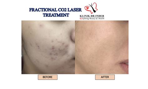 Fractional Co2 Laser Scars Removal Laser Treatment Aesthetic Clinic