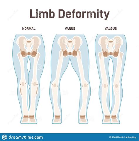 Limb Anatomy Scheme Valgus And Varus Leg Deformities Stock Vector Illustration Of Genu Ankle