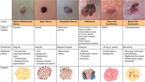 Basal Cell Carcinoma Images