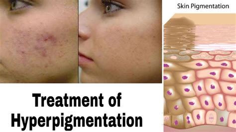 Treatment Of Hyperpigmentation Theprettylooks Youtube