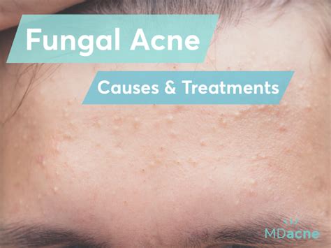 Fungal Acne Causes And Treatments Mdacne
