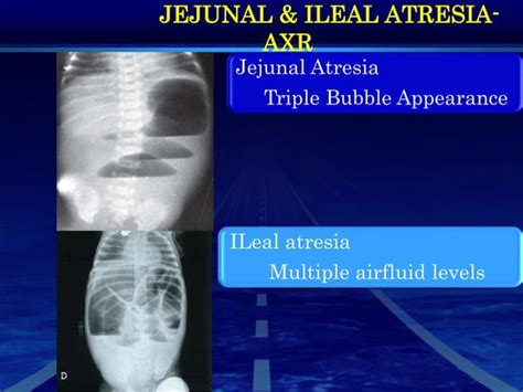 Neonatal Bilious Vomiting Part1