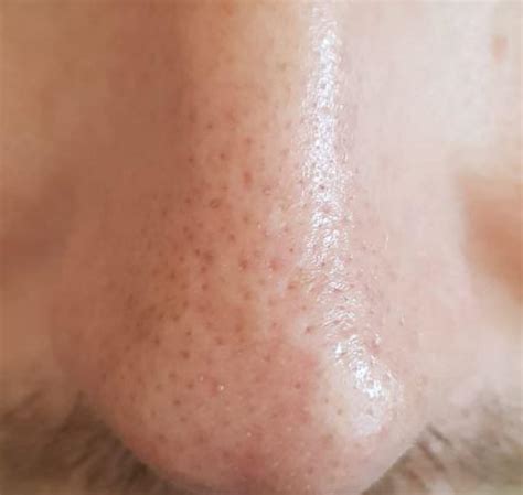 Sebaceous filaments are known to be tiny and small accumulations of sebum and dead skin cells that are formed around the hair where are these sebaceous filaments found and how to get rid of them? Skin Concerns Advice for removing Sebaceous Filaments on ...