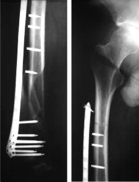 Radiograph Of The Distal Femur Nine Months After Revision