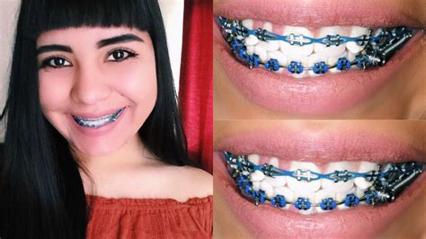 braces plus braces spring herbst appliance up close youtube