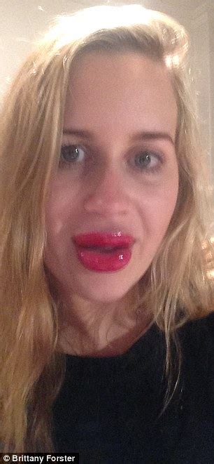Australian Woman Buys A Lip Enhancer Online And The Results Are Not