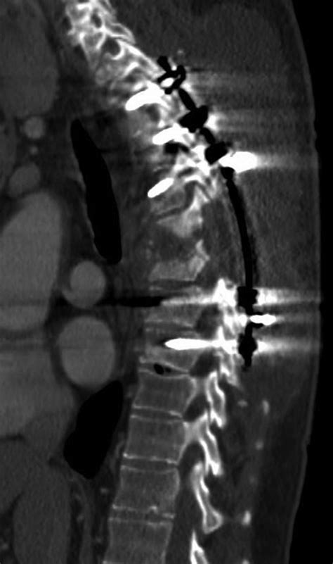 Postoperative Sagittal Ct Scan Of The Thoracic Spine Demonstrating