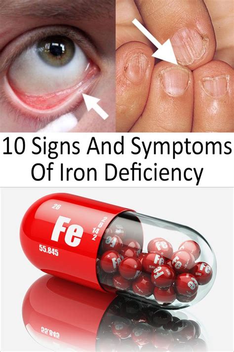 10 Signs And Symptoms Of Iron Deficiency Iron Deficiency Signs Of