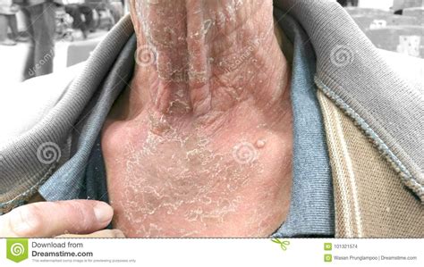 The Infected Skin Begins To Peel Off Neck Stock Photo Image Of
