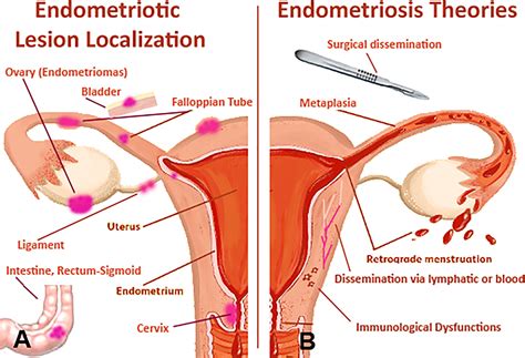 Frontiers Immunological Basis Of The Endometriosis The Complement
