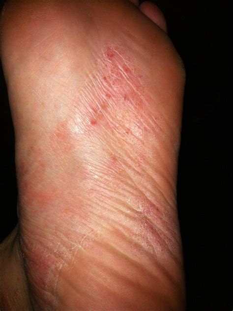 Rasheczema On The Soles Of My Feet Started At The Sides Of My Feet