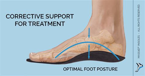 Heel Pain Causes And Treatment Mass4d® Insoles Mass4d® Foot Orthotics