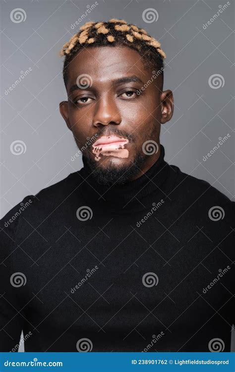 African American Man With Vitiligo Skin Stock Photo Image Of Skin