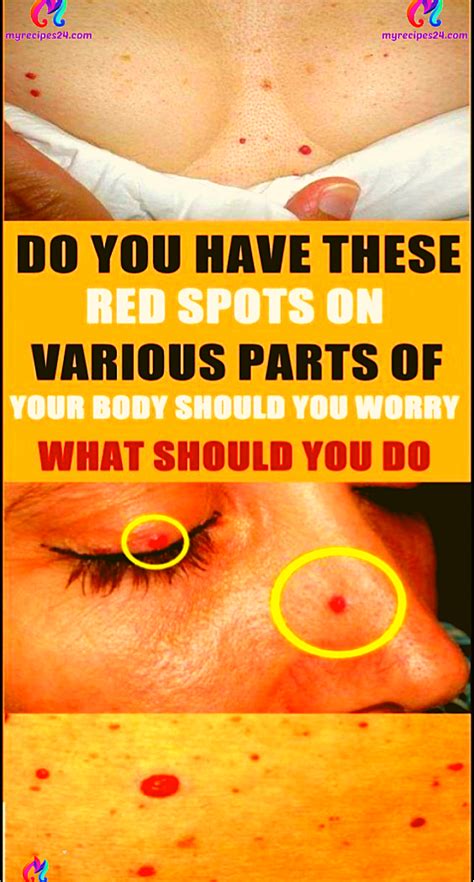 Do You Have These Red Spots On Various Parts Of Your Body Kilkiz