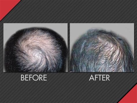Maxim Hair Restoration Updated May 2024 5250 Cherokee Ave