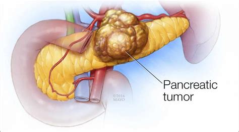 Ce trebuie să ştii despre cancerul de pancreas Simptome factori de
