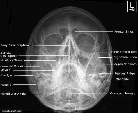 Waters View Of Maxillary Sinus Facial Bones Medical Radiography