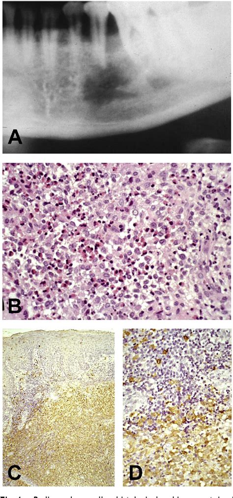 Figure 1 From Eosinophilic Granuloma Of The Mandible Mimicking A
