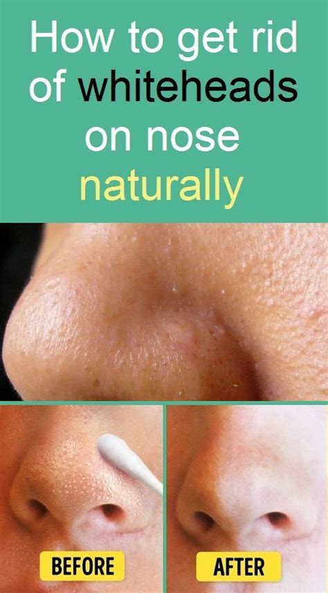 How To Get Rid Of Whiteheads On Nose Naturally Greasy Face