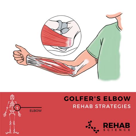 Golfers Elbow Rehab Science