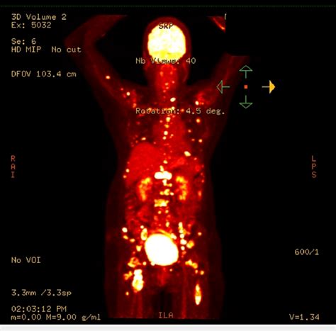 Positron Emission Tomography Pet Scan Showed Numerous Hypermetabolic