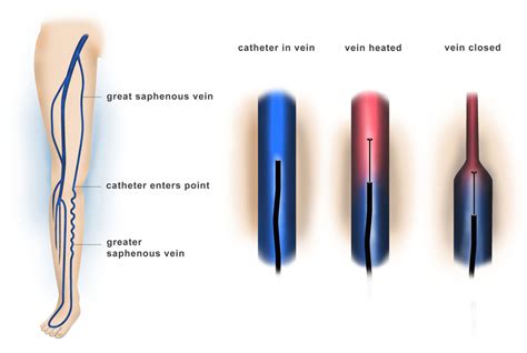 Endovenous Vein Ablation And Stab Phlebectomy Dr Ahmed Farah Abdulrahman