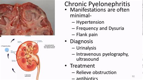 Pathophysiology Renal 3 Uti Acute And Chronic Chronic Kidney Disease