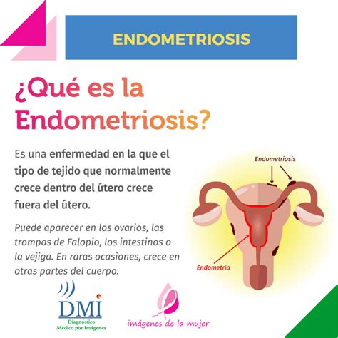 Carlo bulletti, maria elisabetta coccia, silvia battistoni. ¿Qué es la Endometriosis? — DMI - Diagnóstico Médico por ...