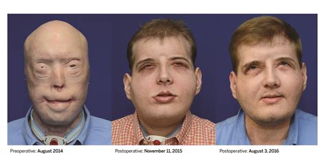 Car Accident Victims Face