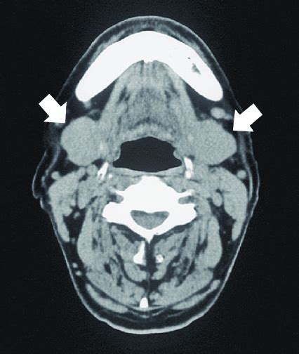 Cervical Ct Images Of Case 1 Bilateral Swelling Of The Submandibular