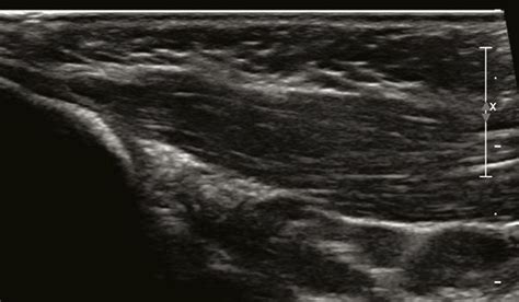Longitudinal Ultrasound Image Of The Right Sternocleidomastoid Muscle