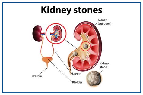 Effective Diet Tips For Kidney Stone Patients