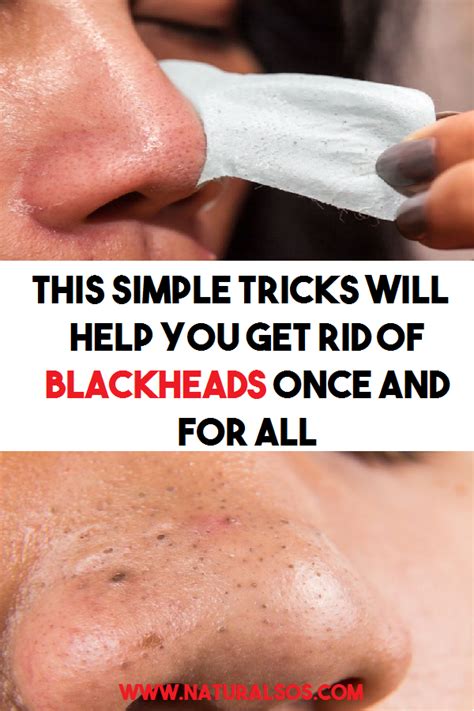 How To Remove A Blackhead A Complete Guide Ihsanpedia
