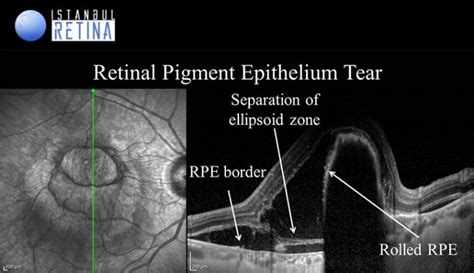 Age Related Macular Degeneration Oct Club