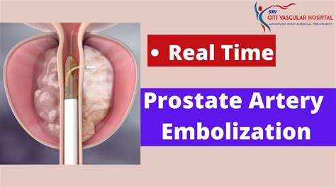 Real Time Prostate Artery Embolization India For Benign Prostate Hyperplasia YouTube