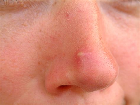 Boil Vs Pimple Tips For Identification