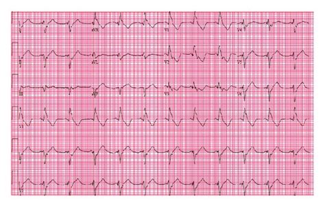 A 12 Lead Electrocardiogram Ecg Showing Right Bundle Branch Block