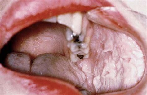 A blue, grey or white appearance of the mucosae, particularly the buccal mucosa. front