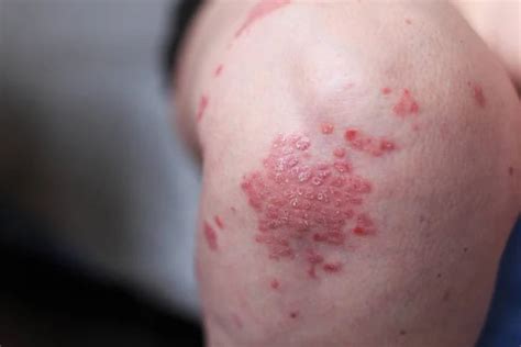 Penyakit Psoriasis Vulgaris Definisi Penyebab Gejala Dan Tata