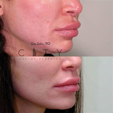 Nyc Nostril Reduction Before And After Pictures New York Ues