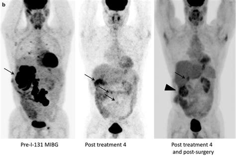 131i Mibg Therapy Radiology Key