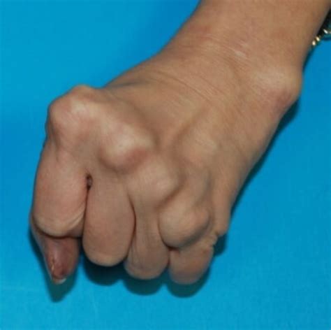 Deformities Of The Hand Hand Surgery Associates