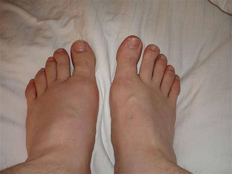 Diabetic With Swollen Feet Effective Health