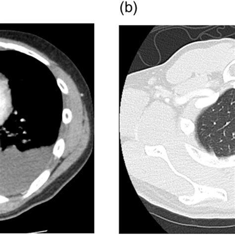 Ct Images Of The Chest At Initial Presentation Revealed Moderate