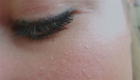 Beauty Skin Bumps Forehead Acne Skin Peeling On Face