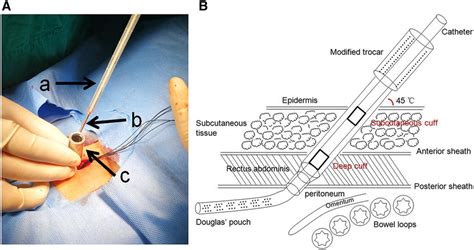 Pd Catheter Insertion A The Outside View Of Peritoneal Catheter