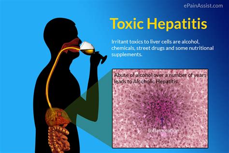 Toxic Hepatitis Treatment Causes Symptoms Risk Factors