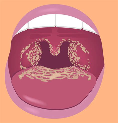 Candida Infection On Lips